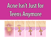 Adult Acne is becoming increasingly common, but there are treatments available.