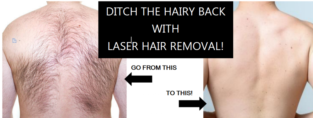 Mens back laser hair removal