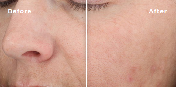 chemical peels for skin before & after
