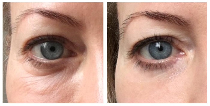 eMatrix laser skin resurfacing before & after pics