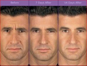 botox before and after pictures - Yep for Men too! | Botox cosmetic, Botox,  Facial rejuvenation